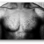 Tinea Versicolor Black Man