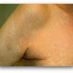 Tinea Versicolor White Man