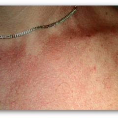 Tinea Versicolor Photo