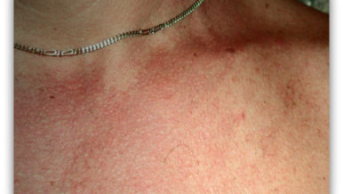 Tinea Versicolor Photo