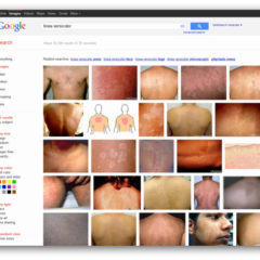 Tinea Versicolor Google Search