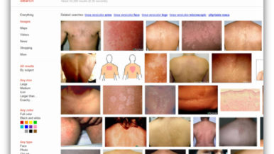 Tinea Versicolor Google Search