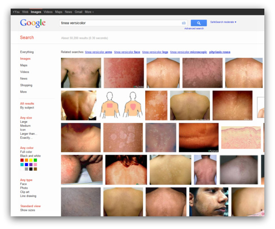 Tinea Versicolor Google Search